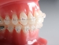 Preview: Agility™ Ceramic, Brackets einzeln, Roth .022"