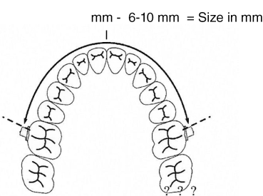 Molaren-Distalisierungs-Bogen, Kit (Größe 1-7) (80 - 98 mm)