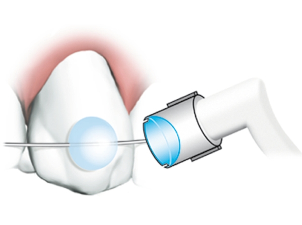 MiniMold System, Lingual retainer